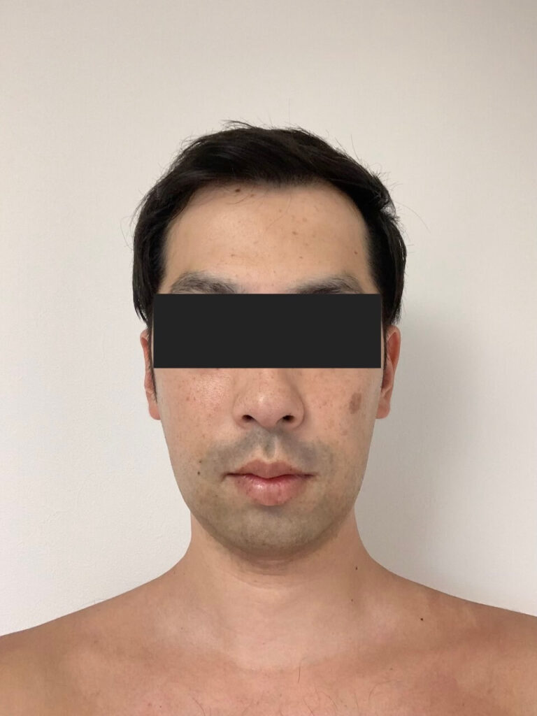 ikeoji-after-1.5-months-face