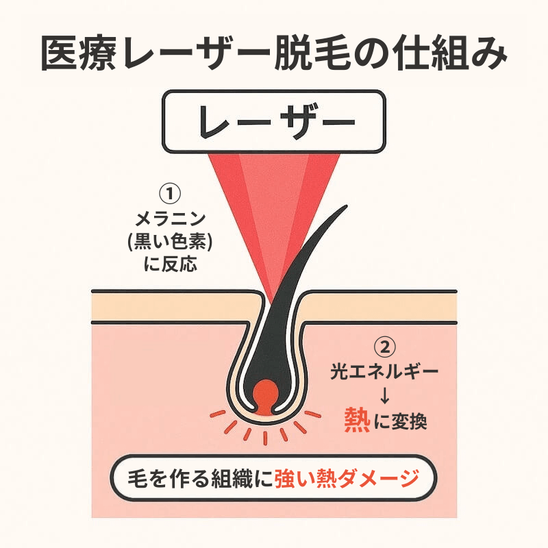 レーザー脱毛の仕組み
