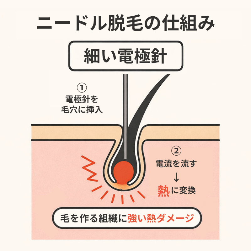 ニードル脱毛の仕組み
