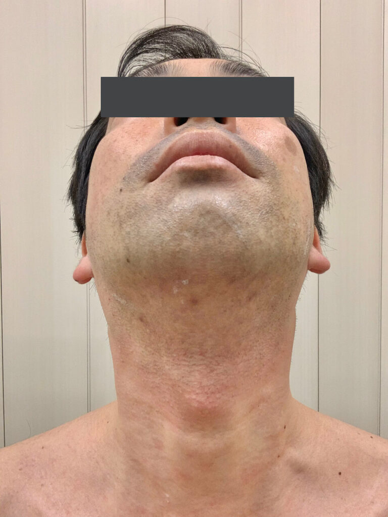 ヒゲ脱毛1回目_あご（After）