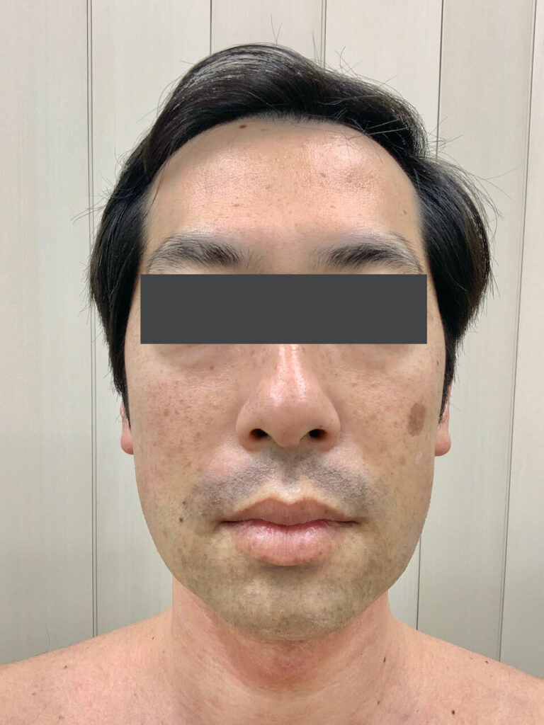 ヒゲ脱毛1回目_正面（After）