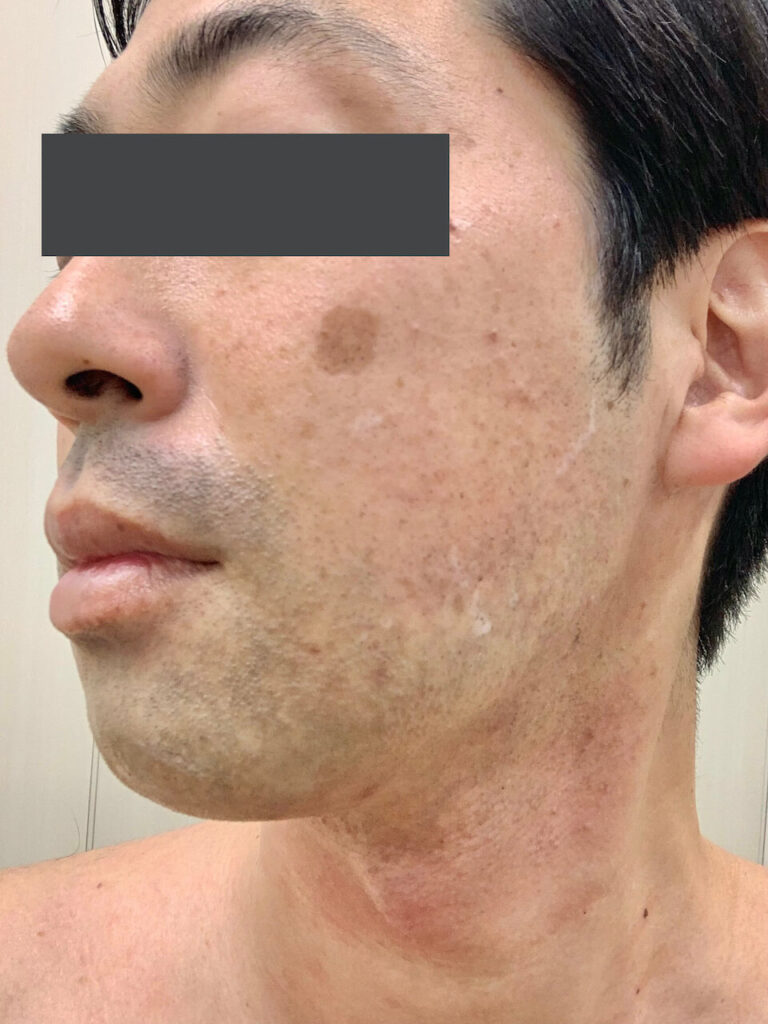 ヒゲ脱毛1回目_左面（After）