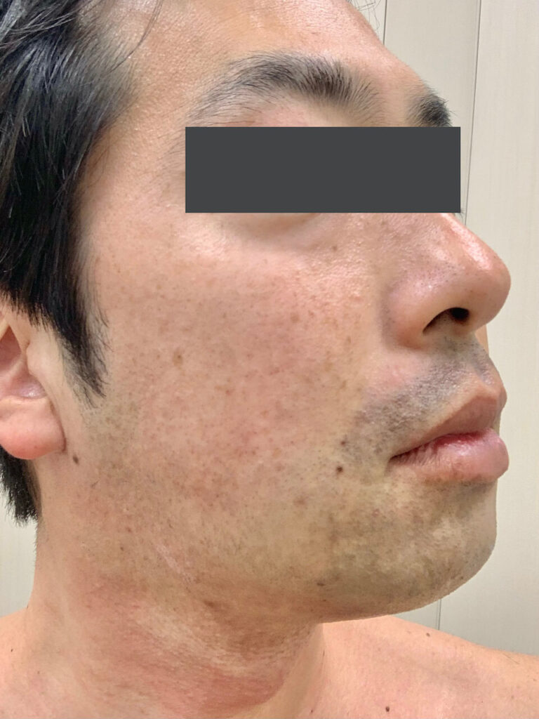 ヒゲ脱毛1回目_右面（After）