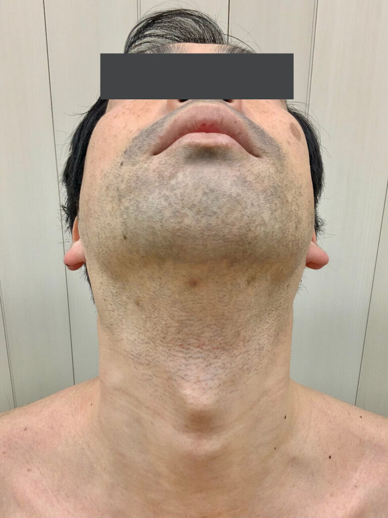 ヒゲ脱毛1回目_あご（Before）