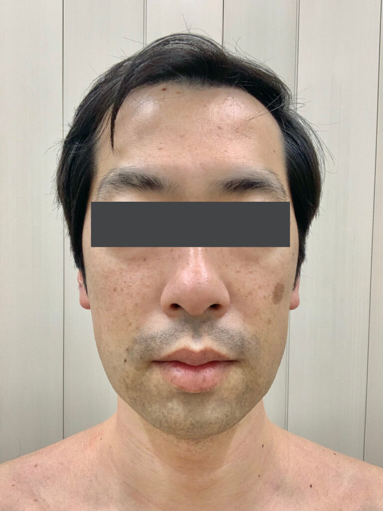 ヒゲ脱毛1回目_正面（Before）