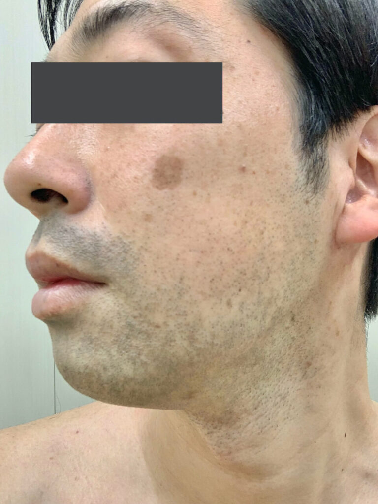 ヒゲ脱毛1回目_左面（Before）