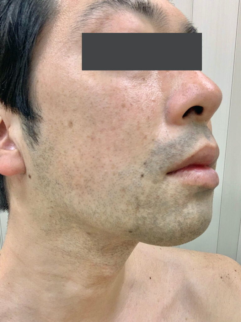 ヒゲ脱毛1回目_右面（Before）