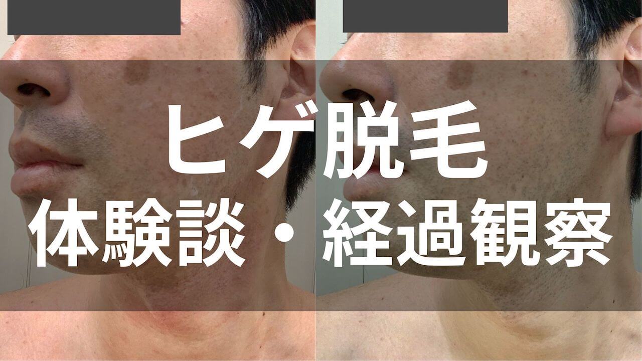 ヒゲ脱毛の体験談・経過観察アイキャッチ