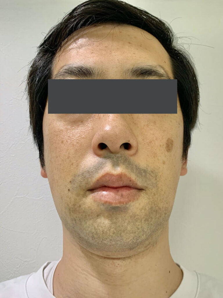 ヒゲ脱毛2回目_正面