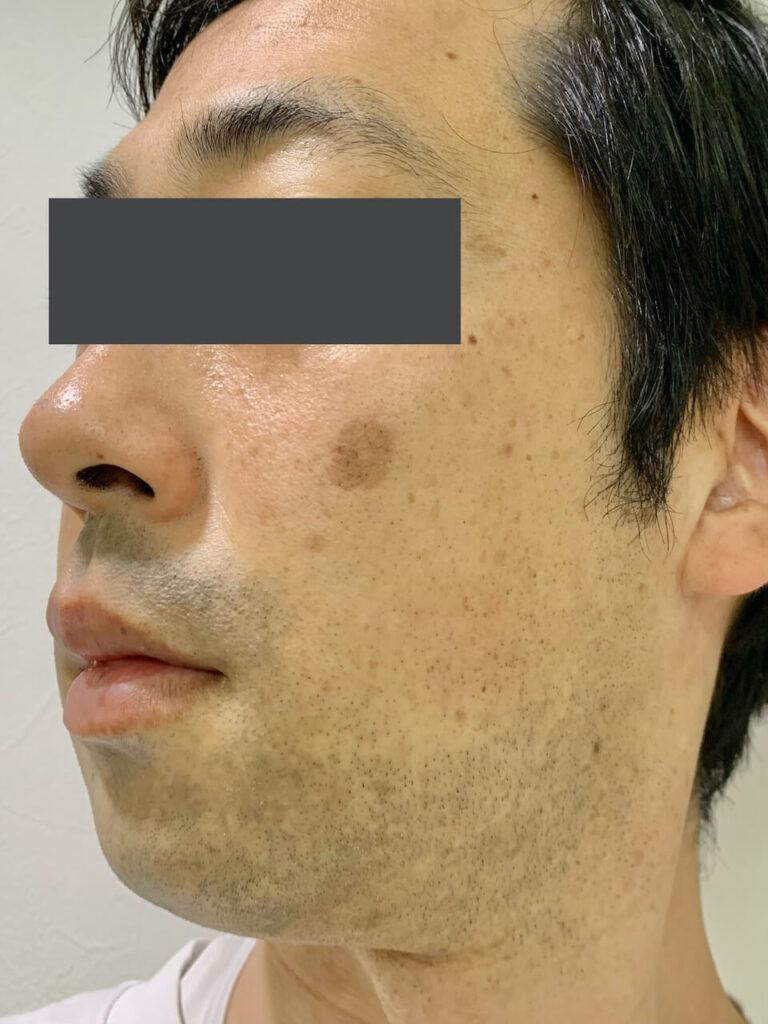 ヒゲ脱毛2回目_左面